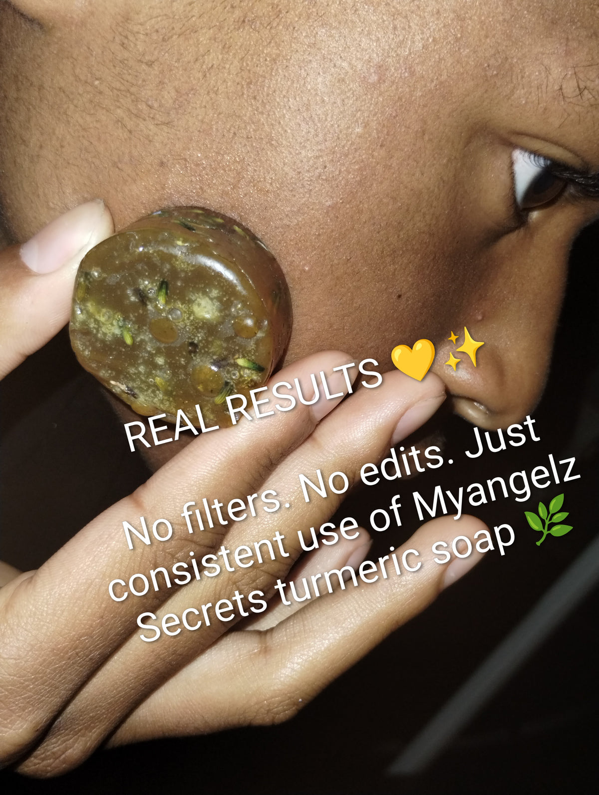 Turmeric Honey Acne Face Soap 🔥🧼